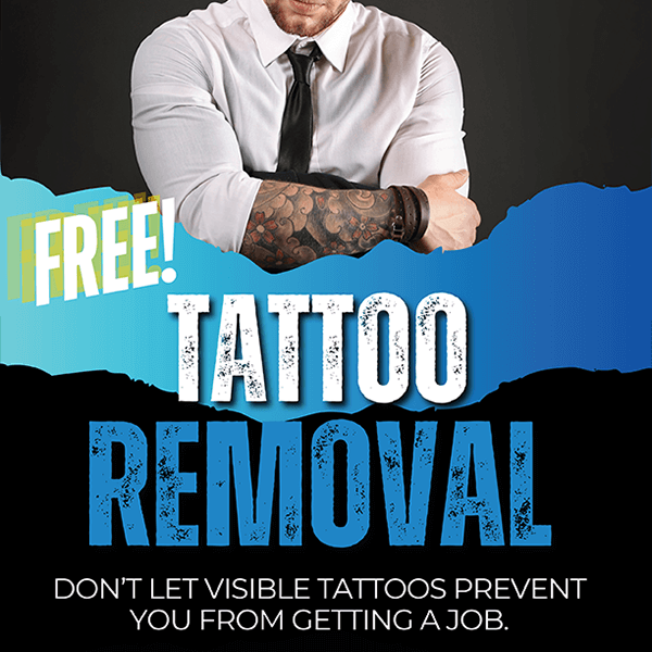Tattoo Removal